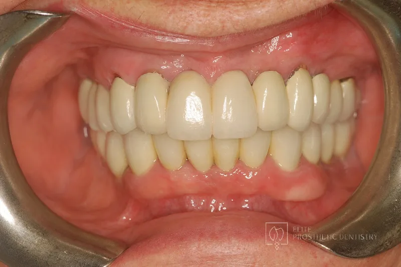 After: retracted view of new restorations with healthy margins and natural color