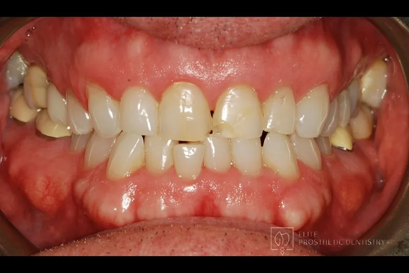 Before: retracted view of chipped, discolored front teeth and aging restorations