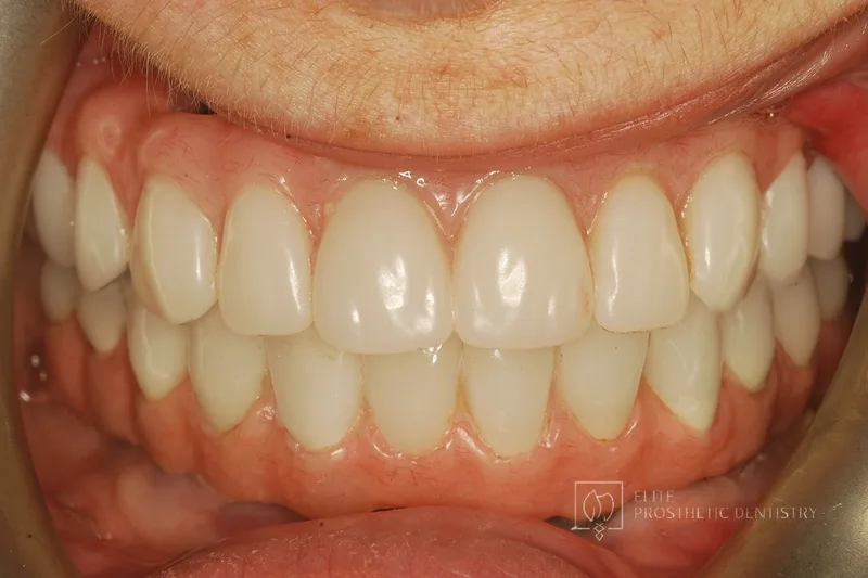 After: full-arch implant revision restored with new zirconia bridgework