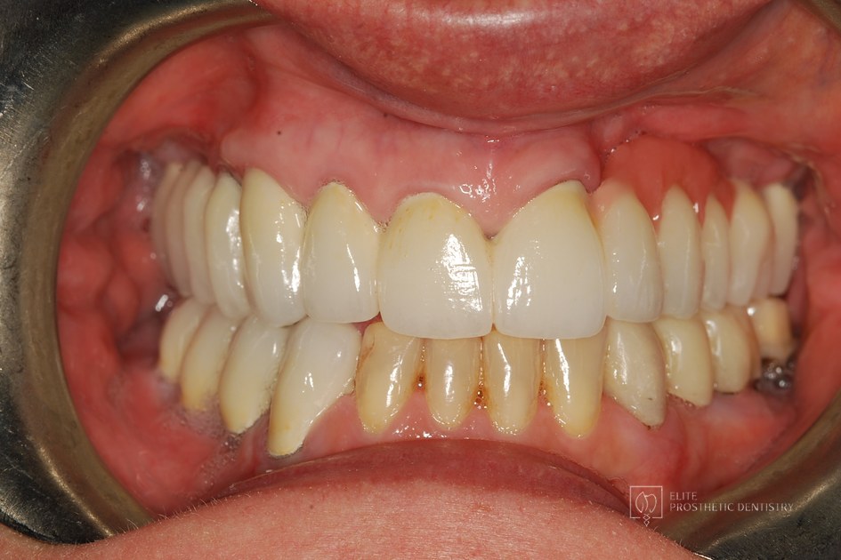 After: retracted intraoral view following the coordinated reconstruction with the long-span upper bridge and restored lower arch