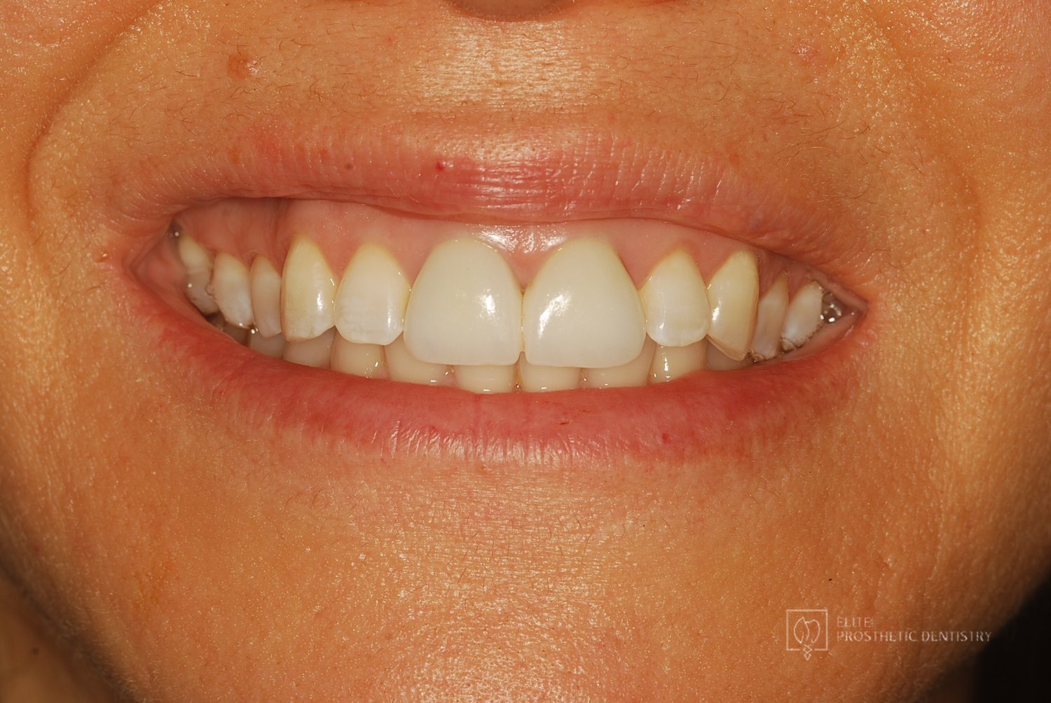 After: natural smile showing the two restored upper front teeth blending with the surrounding teeth