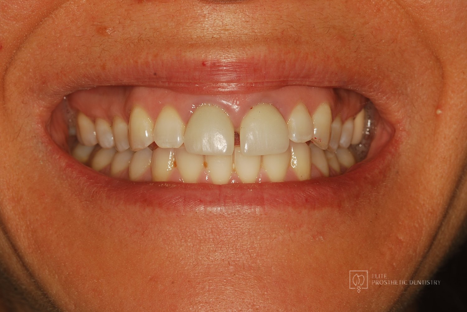 Intraoral view of the upper arch at presentation before treatment