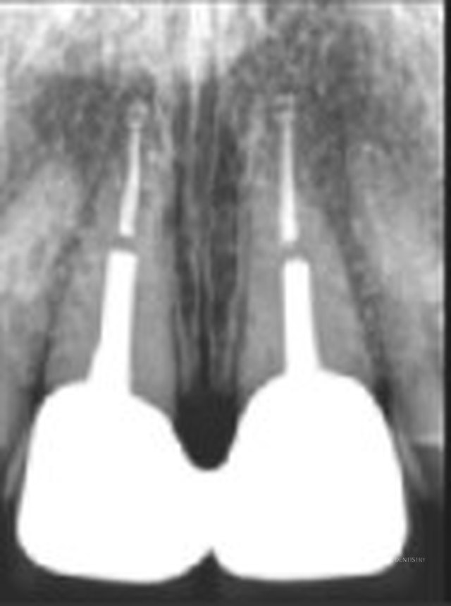 Radiograph of the two completed zirconia crowns supported by the gold-post foundations