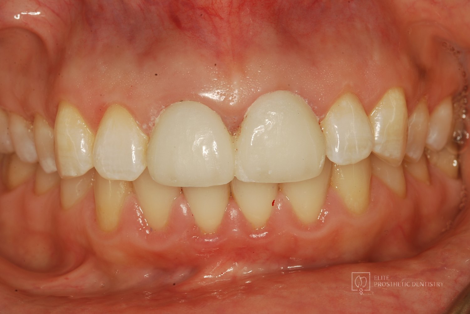 Refined provisional restorations confirming shape and contour before the final crowns were fabricated