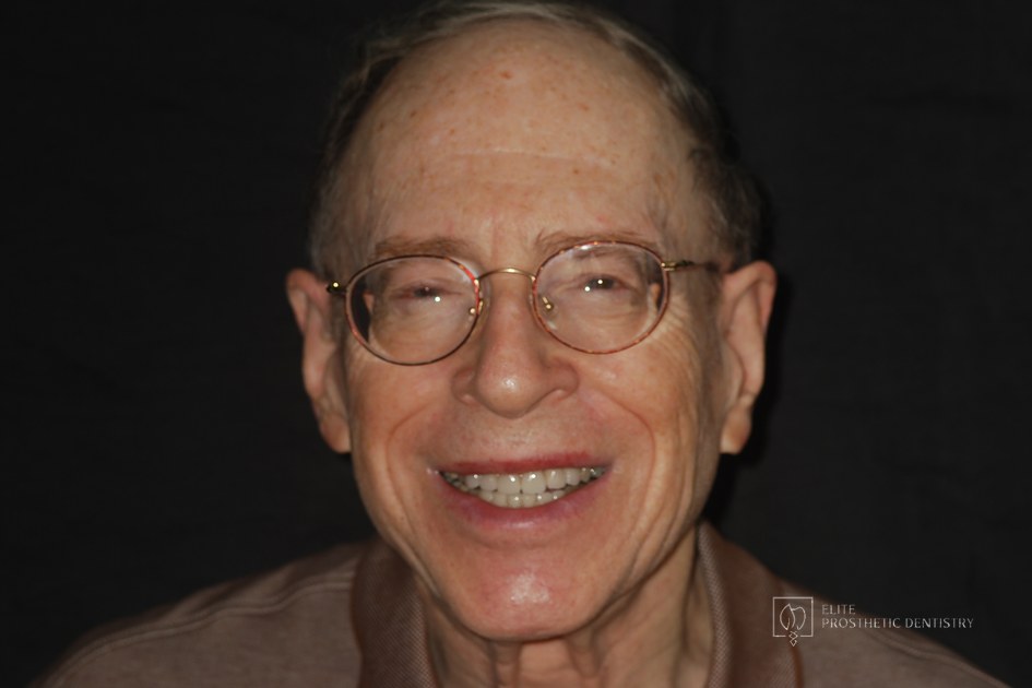 After: How Worn Teeth Were Rebuilt for a Natural, Stable, Long-Lasting Smile