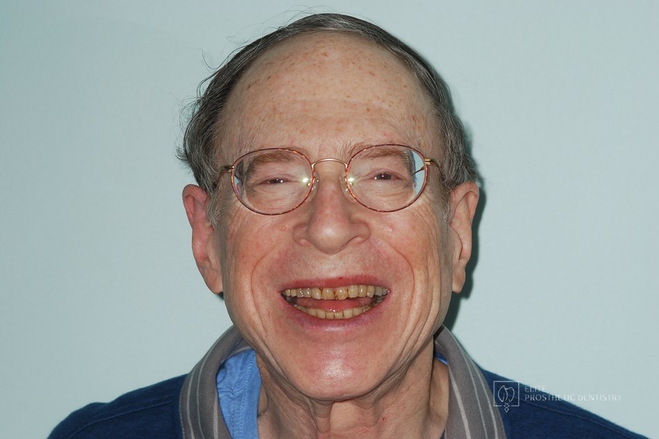 Before: How Worn Teeth Were Rebuilt for a Natural, Stable, Long-Lasting Smile