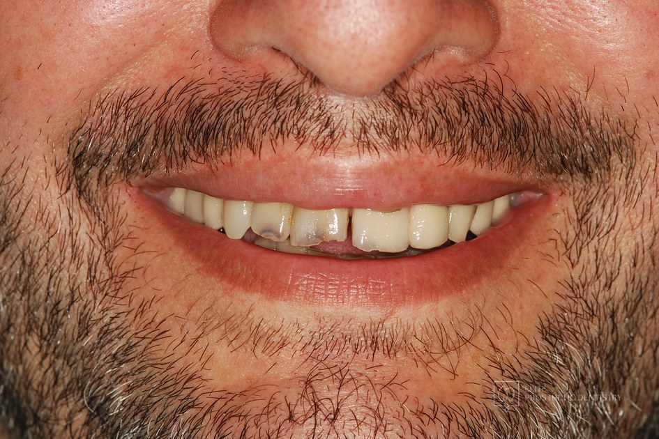 Before: Severe Restorative Breakdown Rebuilt with a Coordinated Full-Mouth Reconstruction
