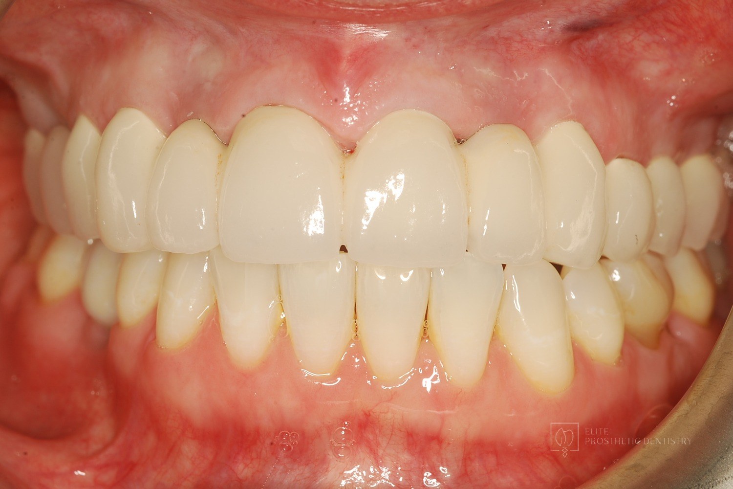 After: How Older Implant Crowns Were Redesigned for a Better Bite and More Natural Appearance