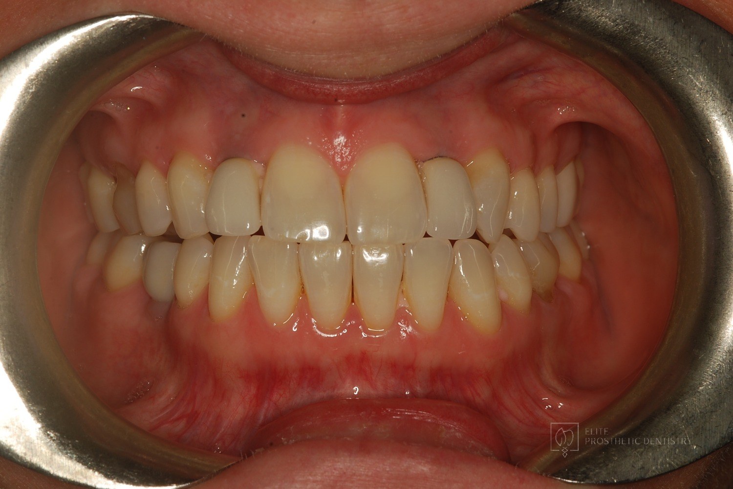 Before: How Older Implant Crowns Were Redesigned for a Better Bite and More Natural Appearance