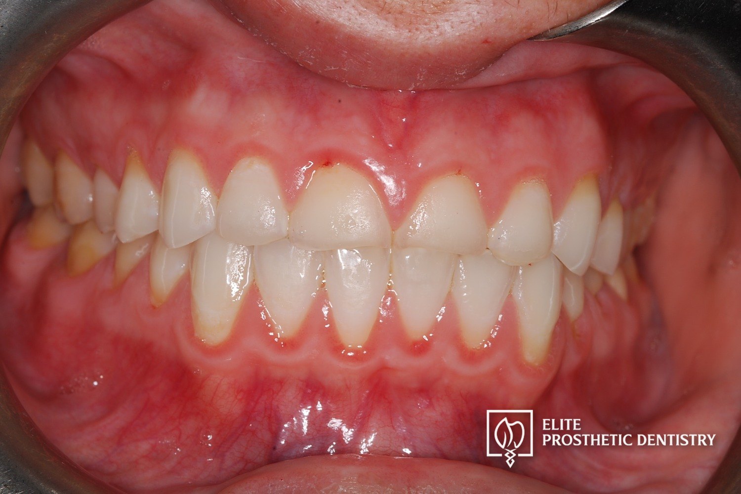 Before: retracted intraoral view showing severe wear and an uneven bite across the full arch