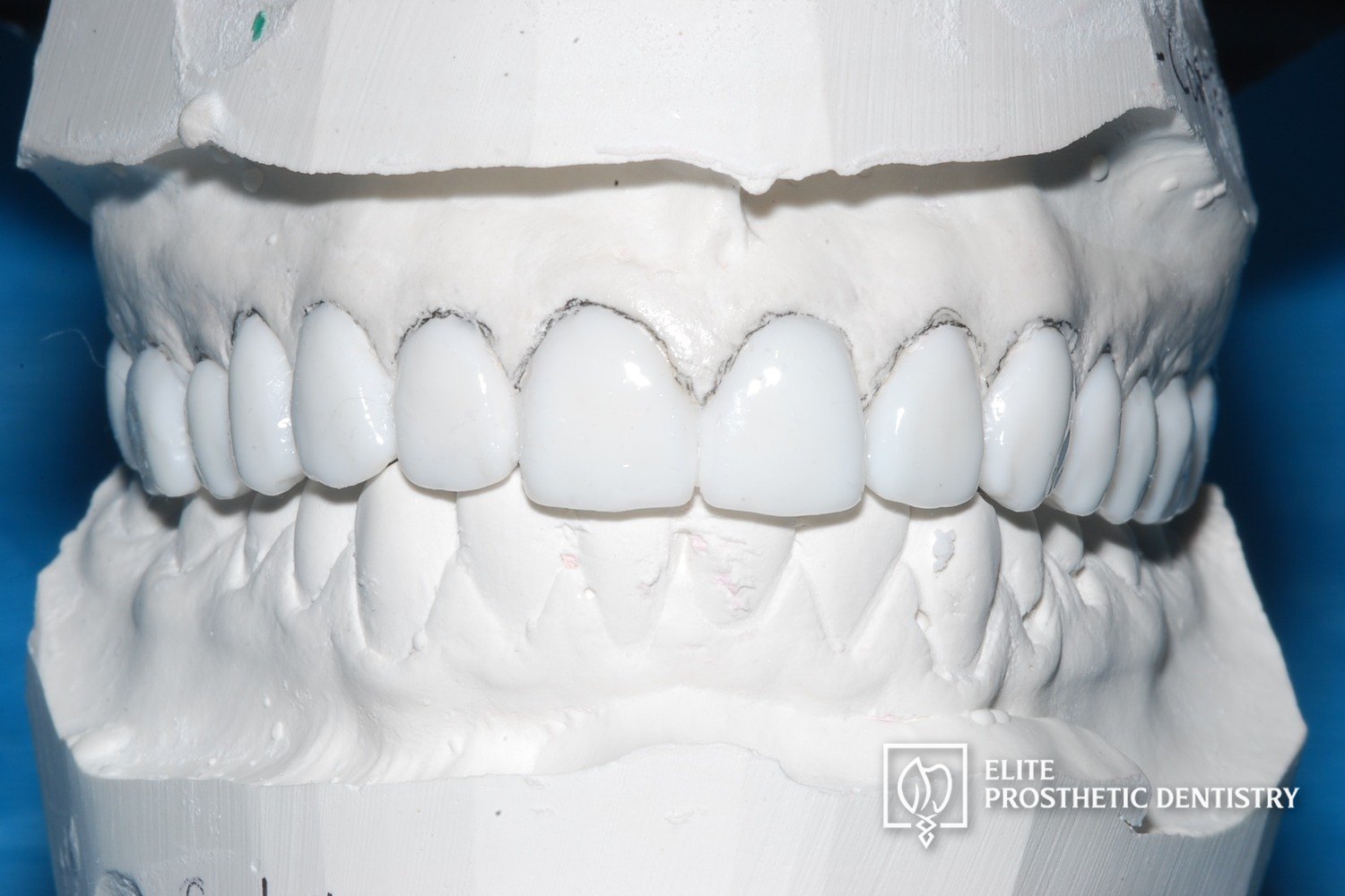 Custom diagnostic wax-up on a stone model previewing the planned tooth shape, length, and proportions before treatment