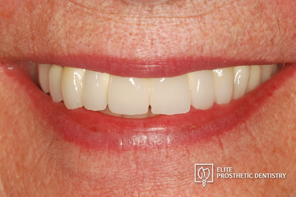 After: How a Loose Upper Bridge and Aging Crowns Were Rebuilt with Staged Implant Reconstruction