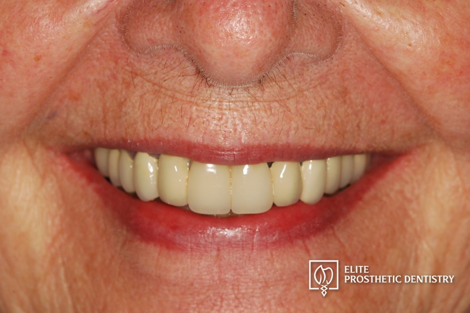 Before: How a Loose Upper Bridge and Aging Crowns Were Rebuilt with Staged Implant Reconstruction