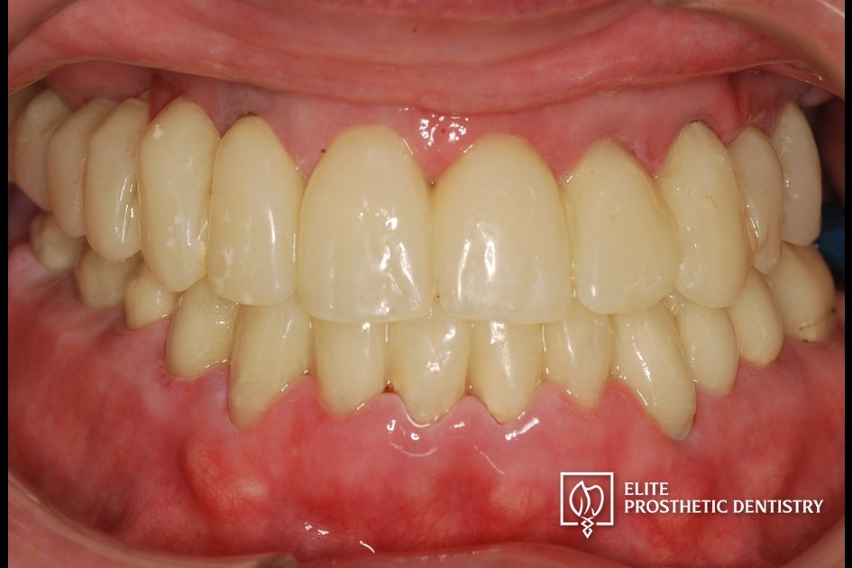 Provisional phase: retracted view of the temporary prosthesis used to verify form, bite, and stability during the staged implant conversion before final fabrication