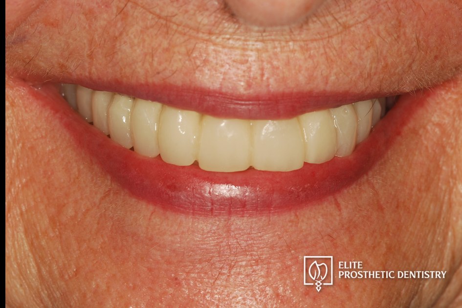 Provisional phase: smile-line view of the custom temporary prosthesis preserving appearance and function during the transition from failing bridgework to implant-supported reconstruction