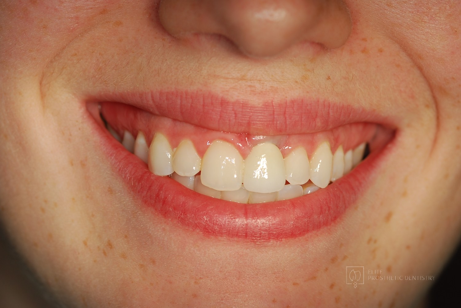 After: How a Front Tooth Lost to Childhood Trauma Was Rebuilt with Bone Grafting and a Long-Lasting Implant