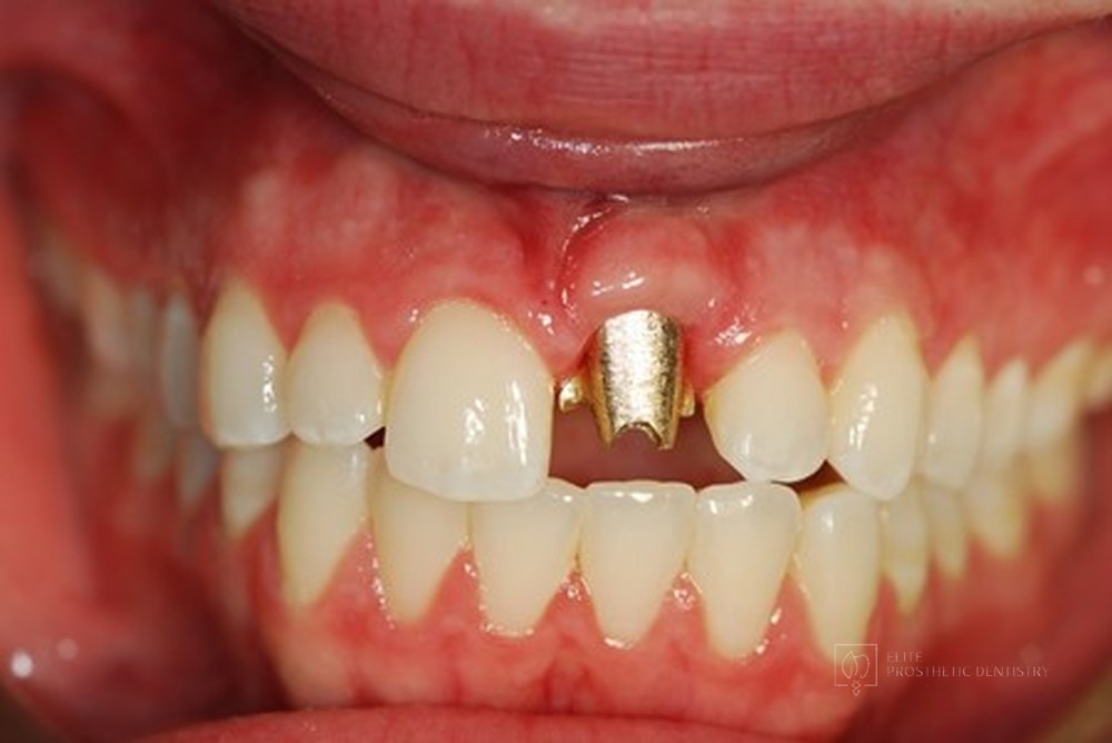 During treatment: the custom implant abutment in place at the upper left central incisor, before the final crown was fitted
