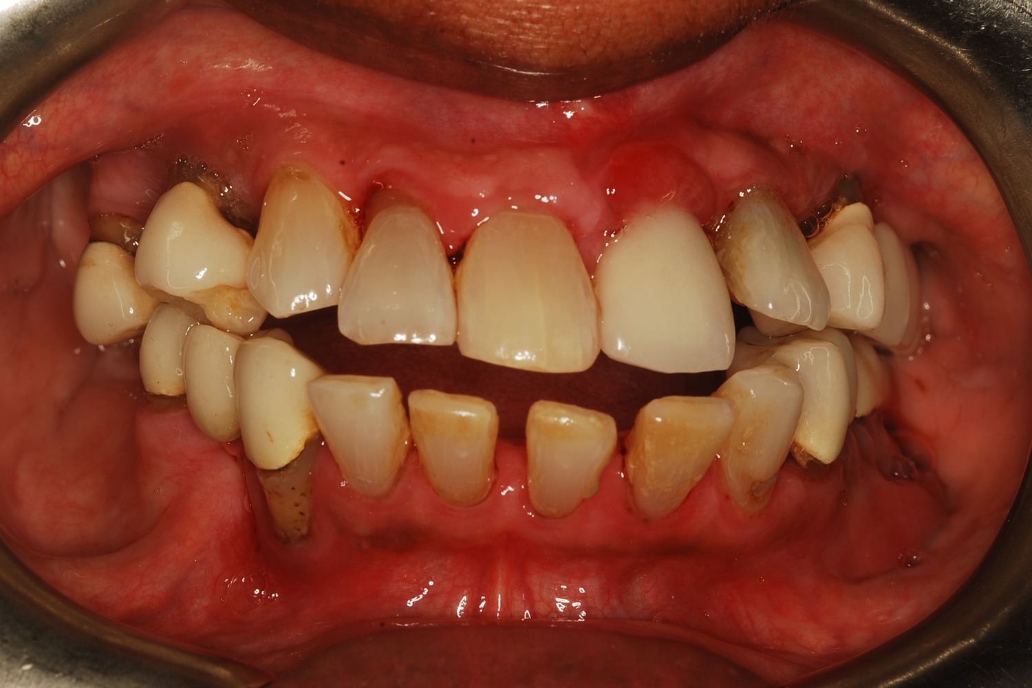 Before: How Severe Bone Loss and Bite Dysfunction Were Rebuilt with All-on-6 Implants and a Milled Zirconia Hybrid Prosthesis
