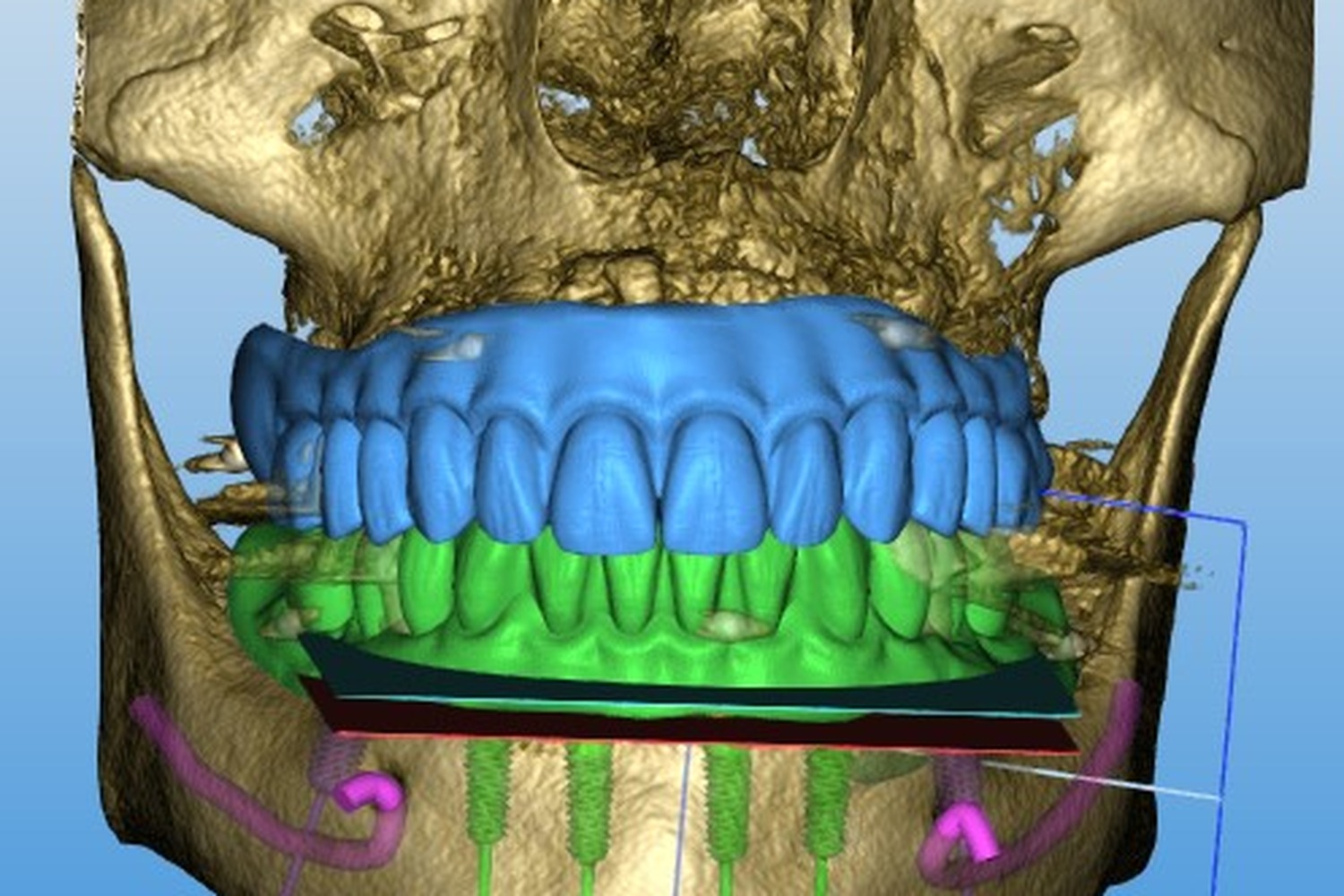CBCT scan used to preplan bone volume, nerve position, and implant receptor sites before surgery