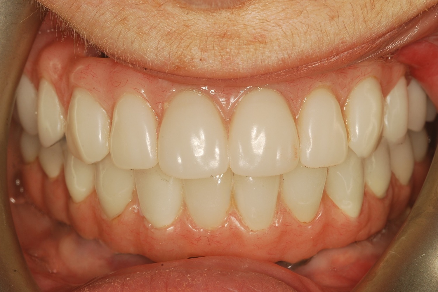 After: How Failing Implants and Severe Bone Loss Were Rebuilt Into a Stable Full-Arch Implant Reconstruction