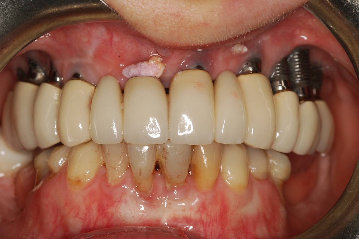 Before: How Failing Implants and Severe Bone Loss Were Rebuilt Into a Stable Full-Arch Implant Reconstruction
