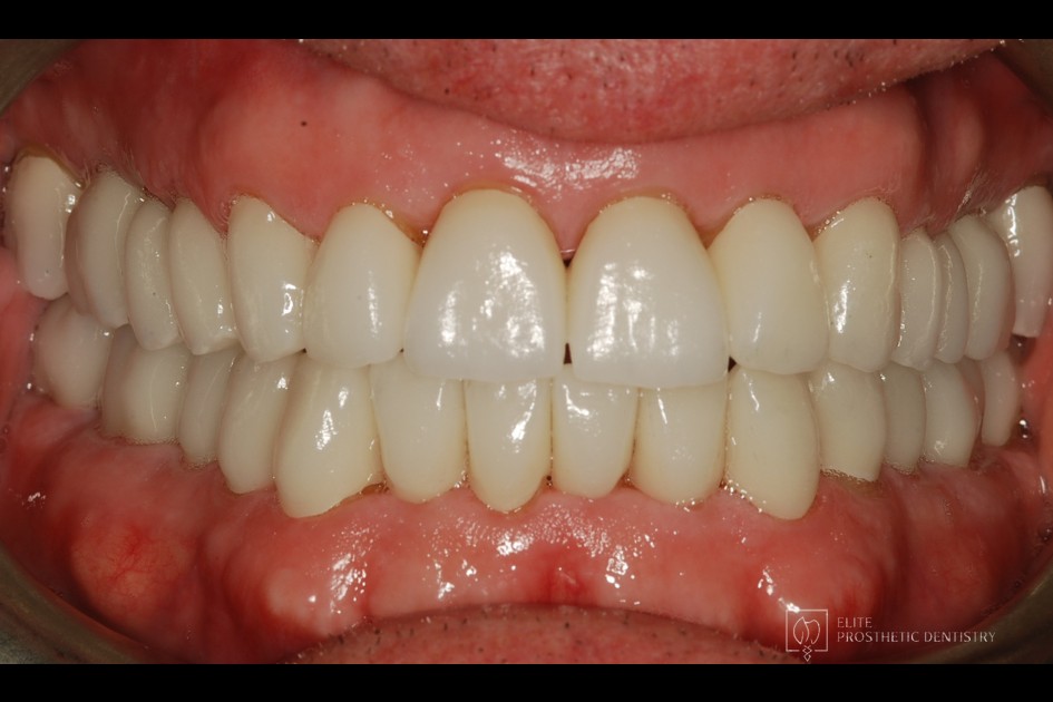 After: retracted intraoral view following the coordinated reconstruction with new crowns and bridge