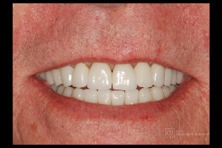 After: close-up view following the coordinated restorative reconstruction with new crowns and bridge