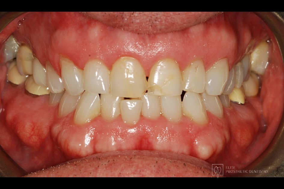 Before: retracted intraoral view documenting the extent of the aging dentistry