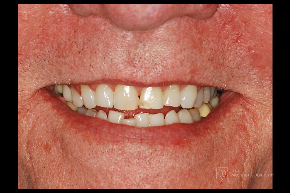 Before: close-up view showing the aging crown work and its margin and color changes