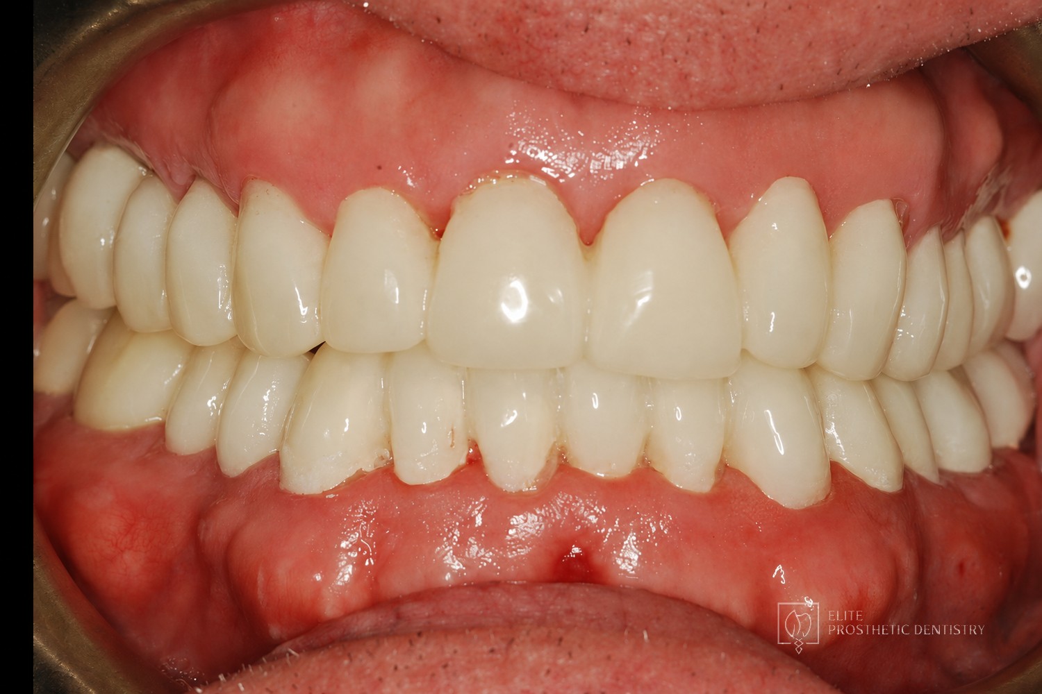 Provisional phase: retracted view of the provisionals in centric occlusion, confirming the design before final fabrication