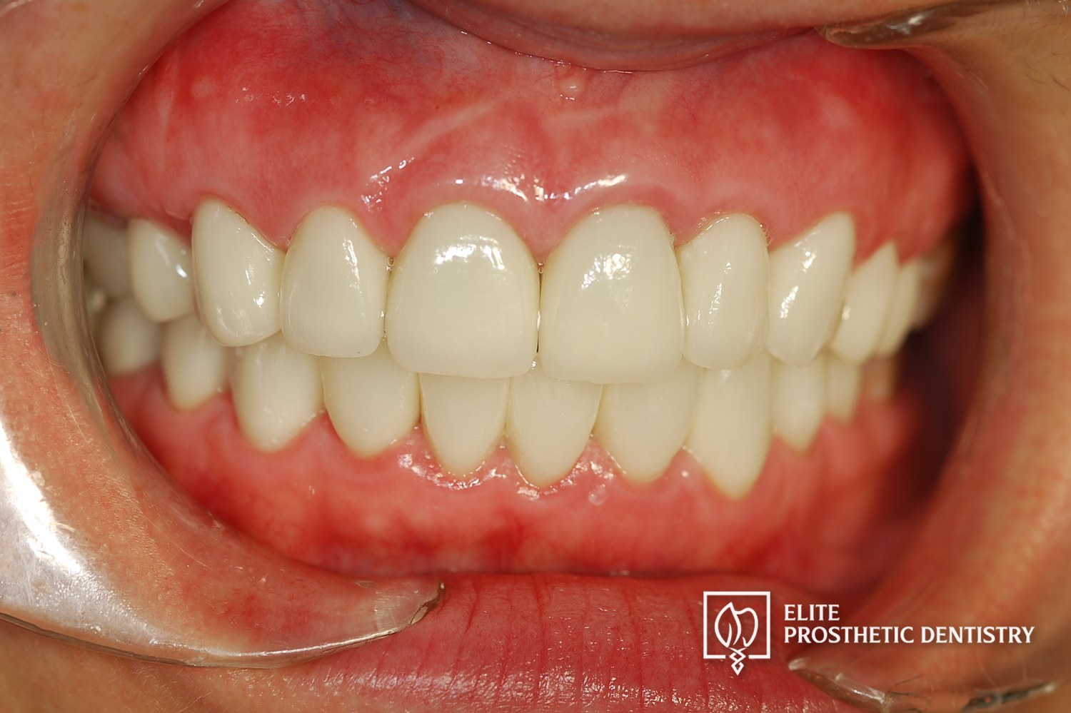 Final intraoral view after replacement with customized ceramic restorations.