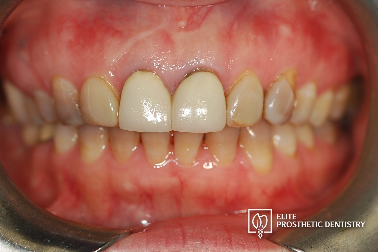 Pre-treatment intraoral view showing aging, opaque ceramic restorations.
