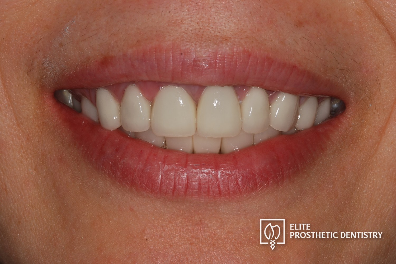 After treatment