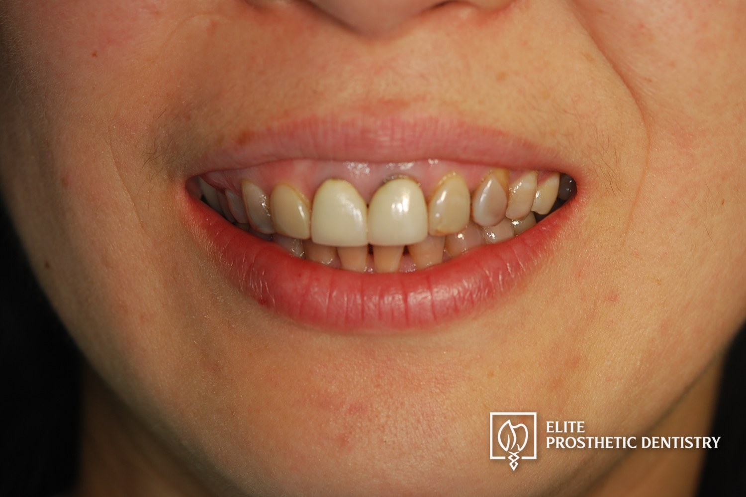 Before treatment